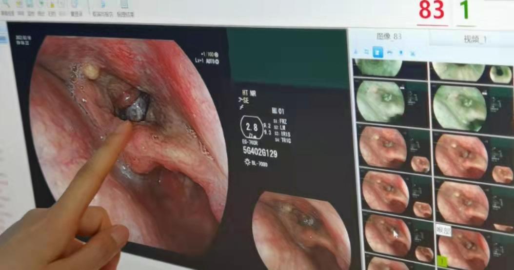 喉癌预防方法大全 如何有效远离喉癌威胁